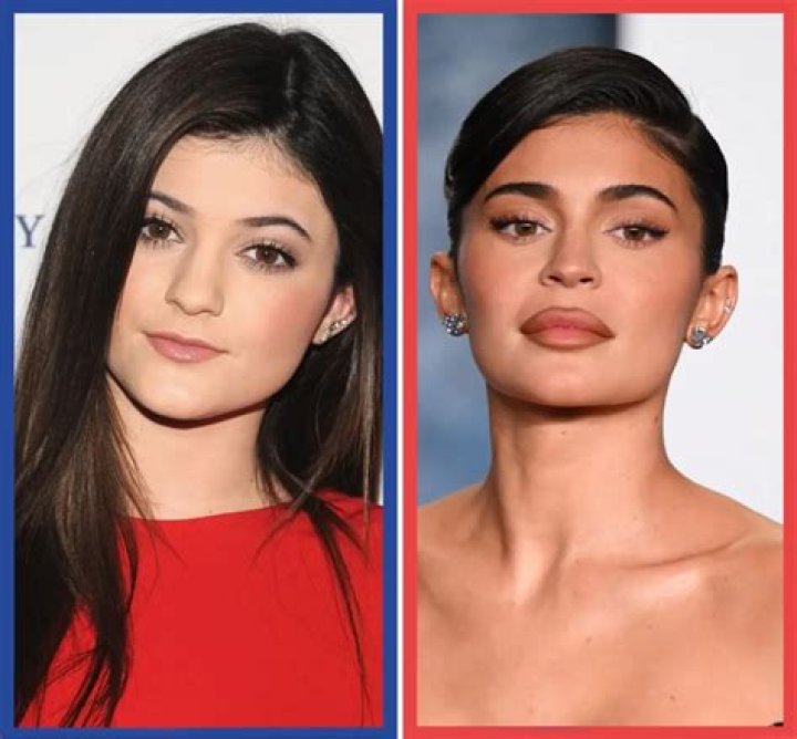 Has Kylie Jenner Had Plastic Surgery?